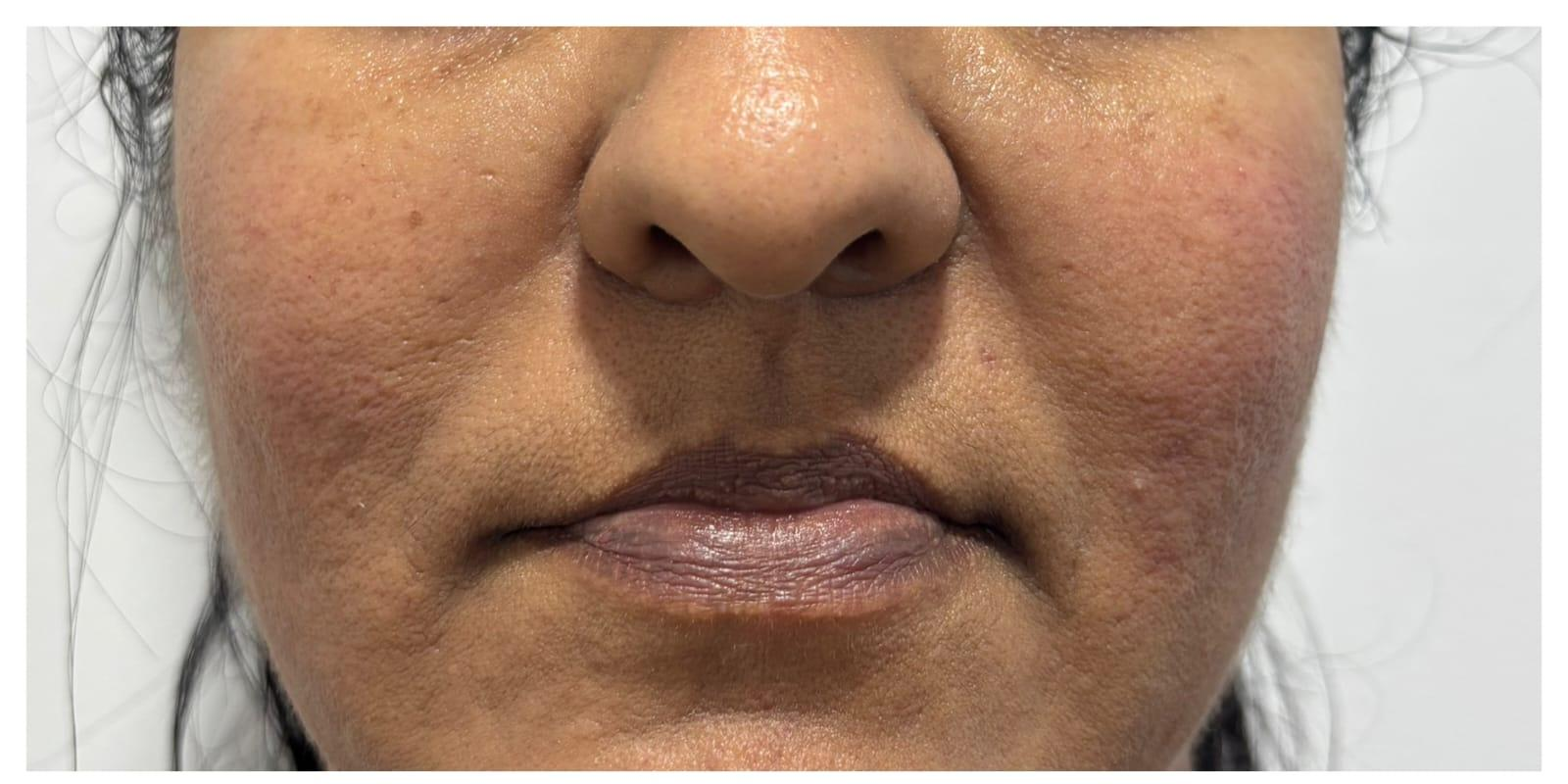 Close-up of a woman's lower face showing prominent pores, uneven skin texture, and redness on the cheeks, with lips closed.