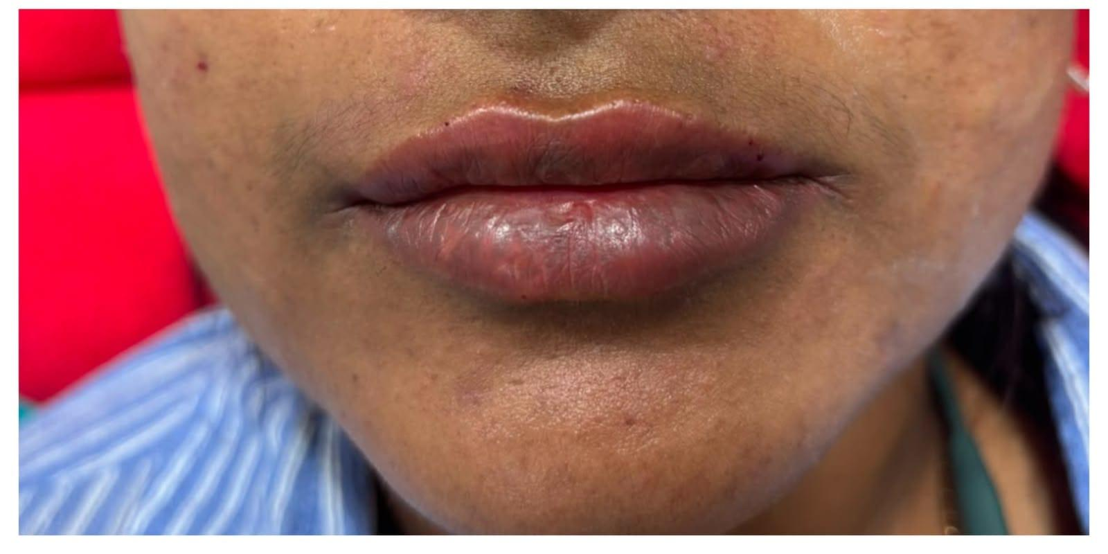 Close-up of a person's lips and lower face with brown skin; lips look slightly dry and chapped, surrounding skin shows small blemishes.