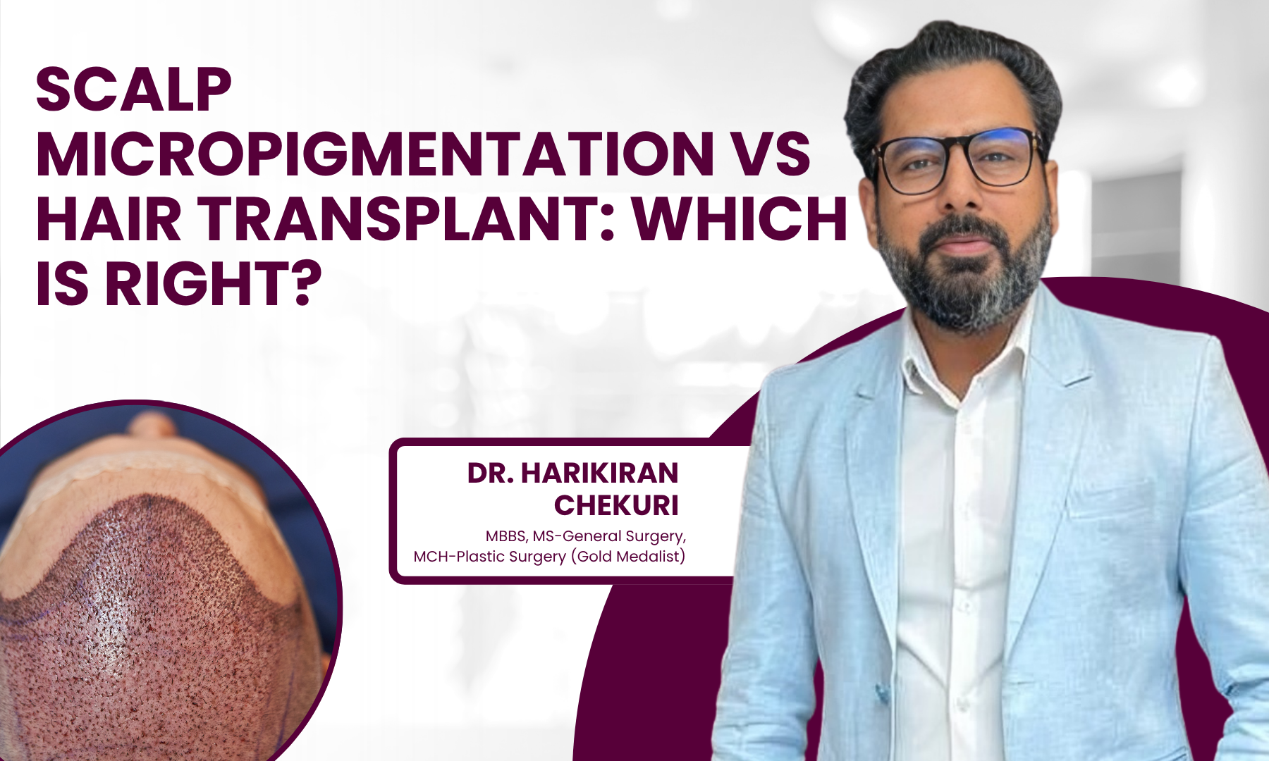Scalp Micropigmentation vs Hair Transplant Which Is Right