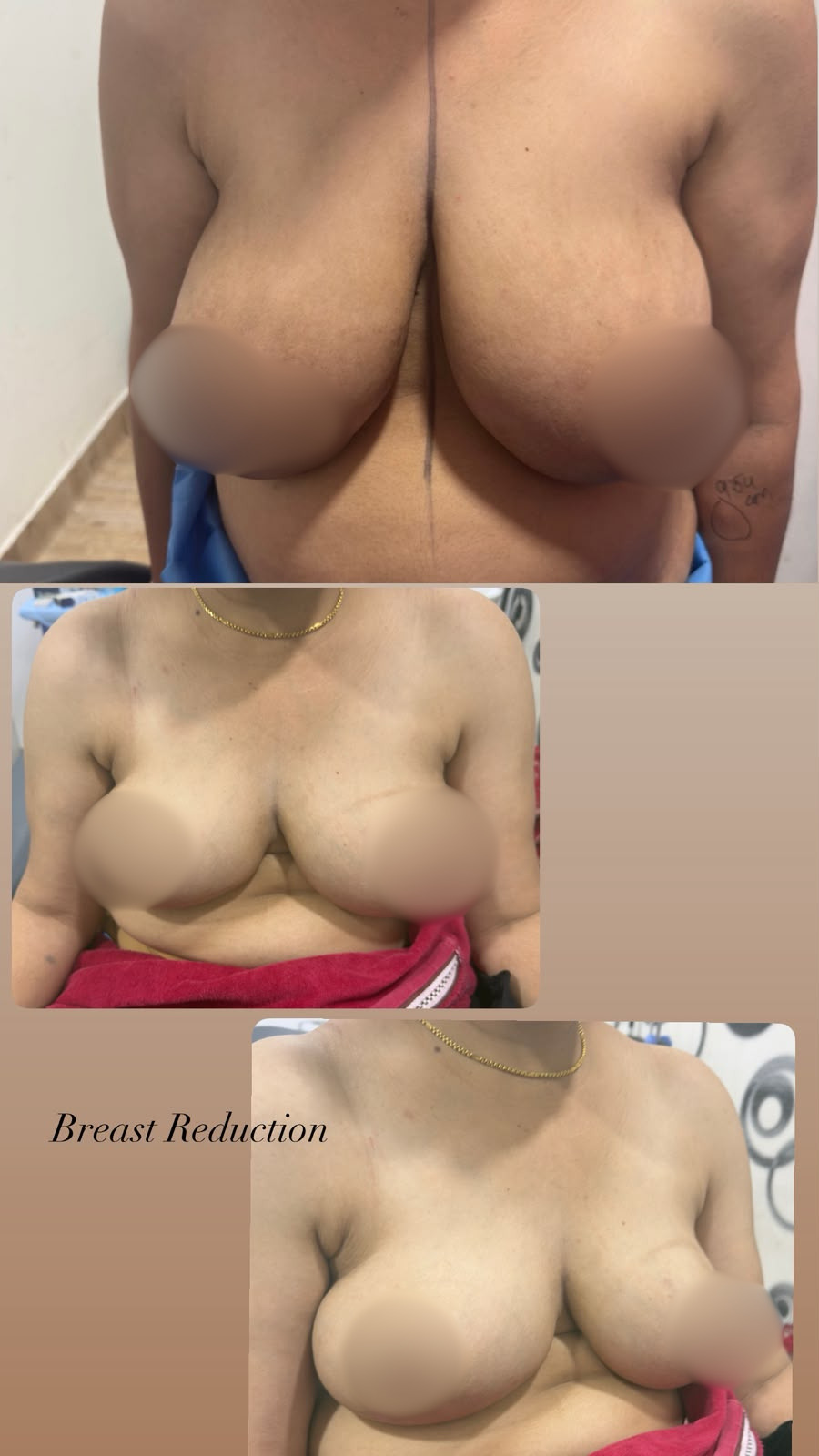 Three-panel collage of a woman's torso showing breast reduction progress: nipples blurred for privacy; first panel shows larger breasts before, second panel shows reduction, and third panel shows final result with toned contour.