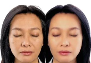 Skin Whitening Treatment in Hyderabad