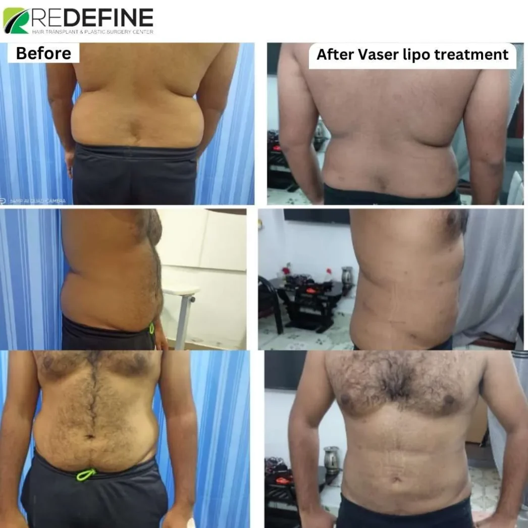 Collage showing before and after Vaser liposuction results for the back and abdomen at ReDefine clinic.