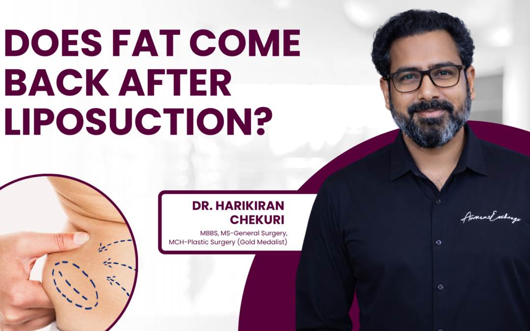 Does Fat Come Back After Liposuction?
