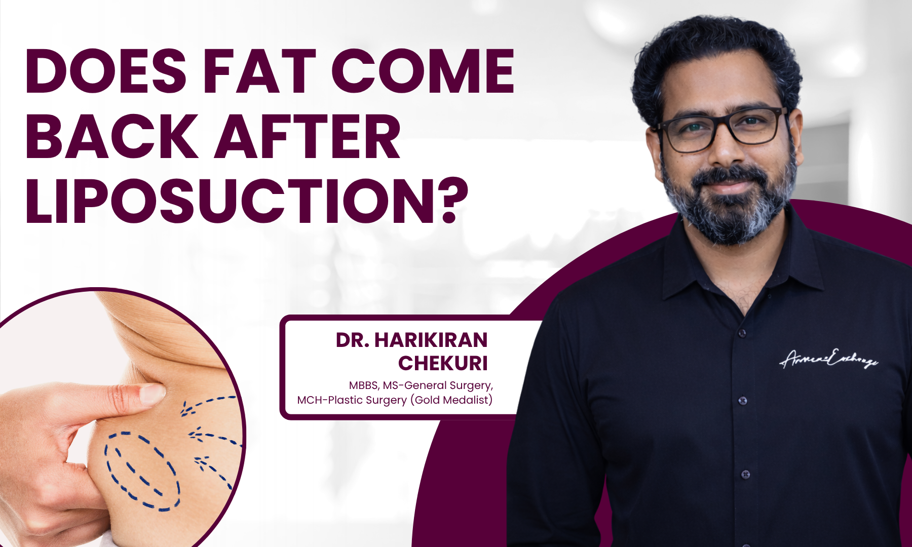 Does Fat Come Back After Liposuction