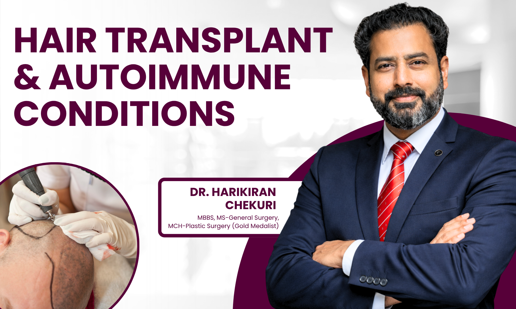 Can Hair Transplant Fail in Patients With Autoimmune Conditions Dr. Harikiran Chekuri