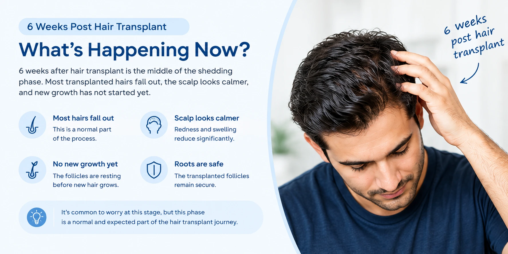 Infographic: 6 Weeks Post Hair Transplant — What's Happening Now? summary of shedding, calm scalp, and growth timeline with icons on left and photo of man on right.