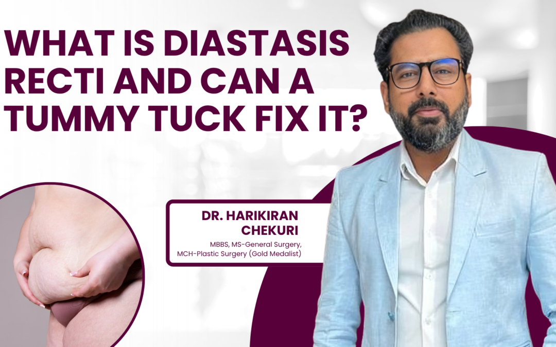 What Is Diastasis Recti and Can a Tummy Tuck Fix It?