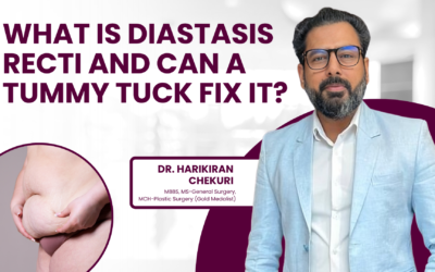 What Is Diastasis Recti and Can a Tummy Tuck Fix It?