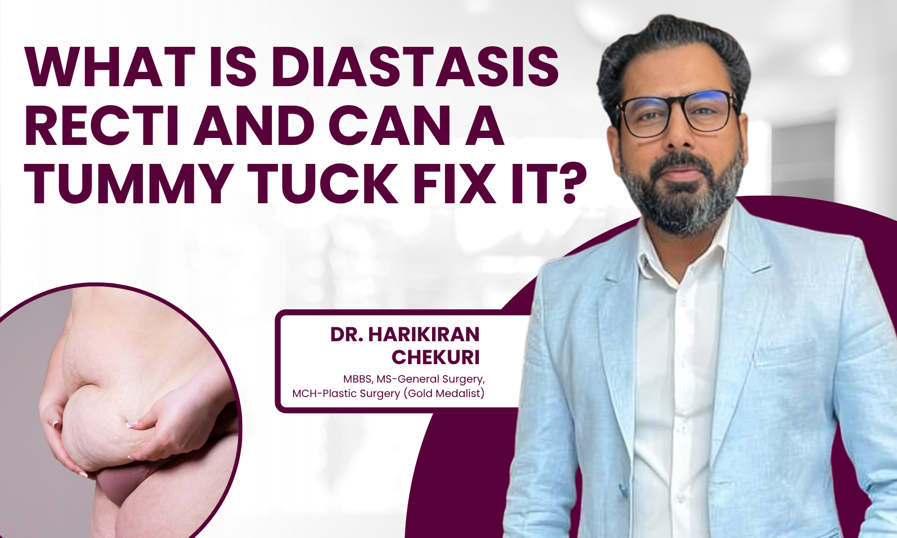 What Is Diastasis Recti and Can a Tummy Tuck Fix It